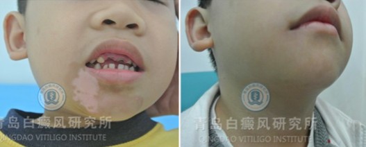 右下颌白癜风成功门诊案例（男，6岁）