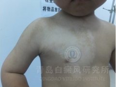 小孩胸部1年多白癜风成功康复案例